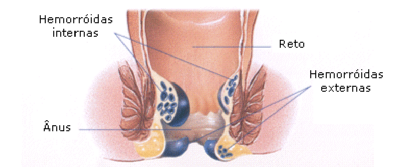 hemorroidas internas