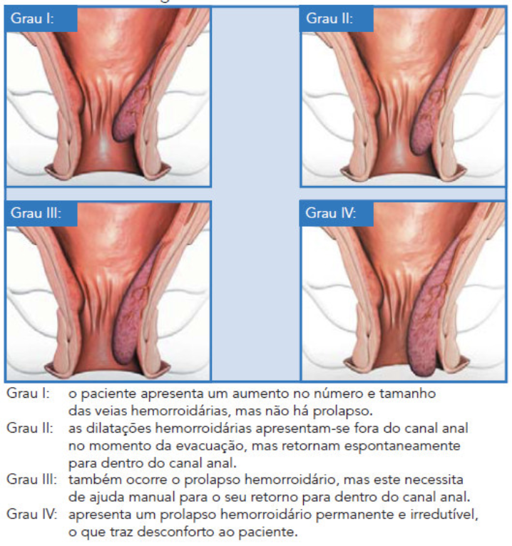 tipos de hemorroidas internas