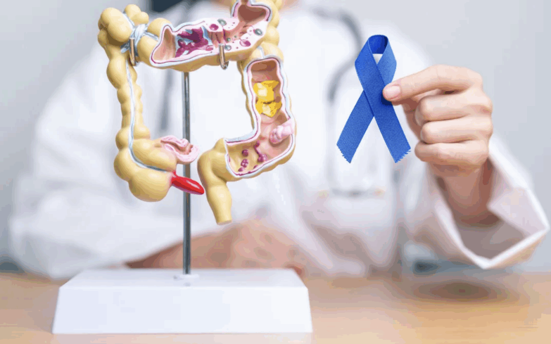 Câncer colorretal: diagnóstico precoce é essencial para salvar vidas